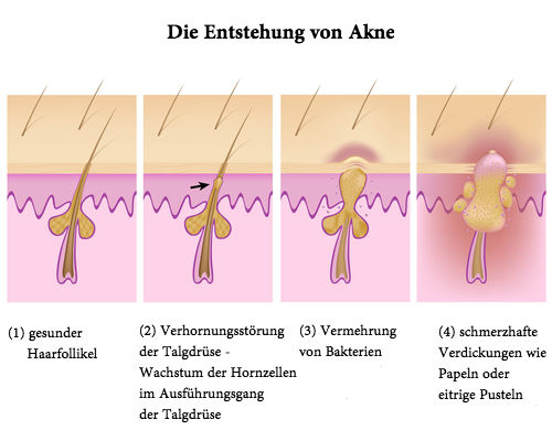 Akne Entstehung